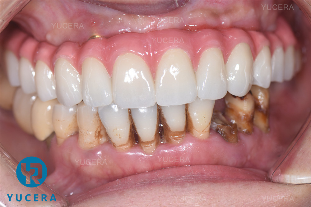 3D Plus Multilayer 43% -57% 6 Layers Dental Block Disc for CAD CAM Crown and Bridge 98mm Open System